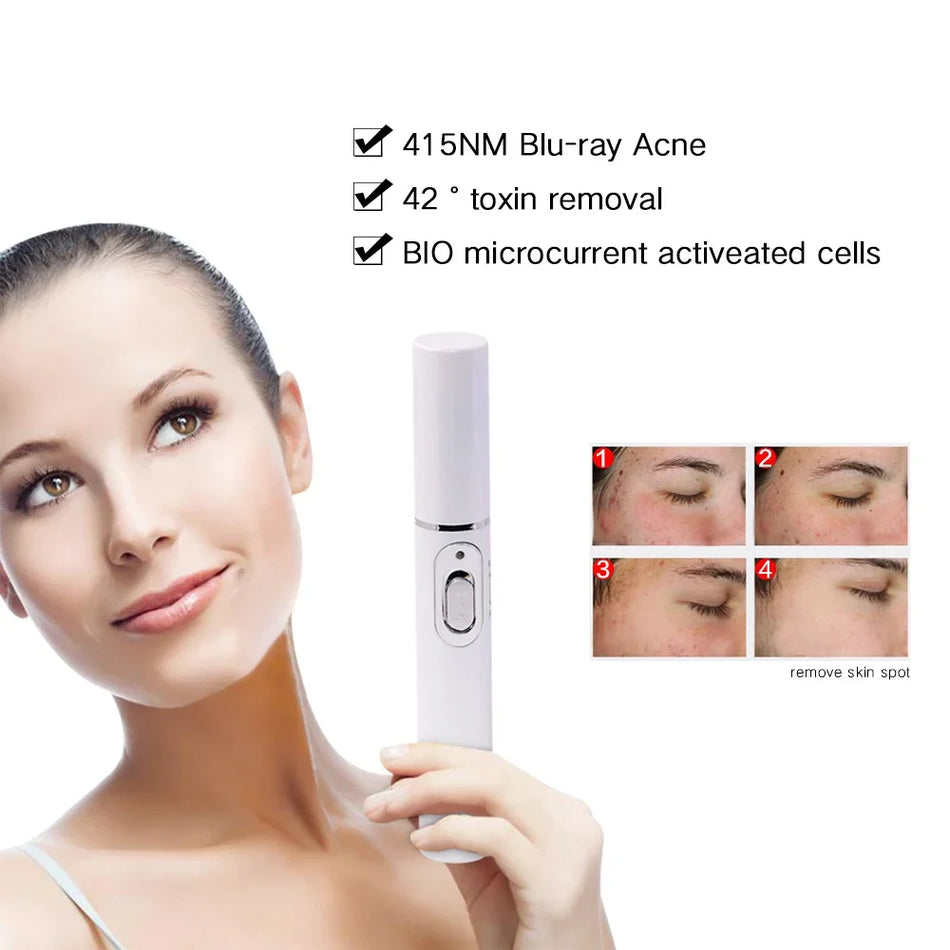 Blue Light Therapy Acne & Wrinkle Removal Laser Pen 🌟